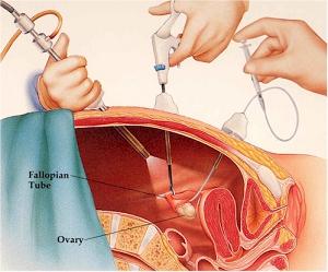 dr_polgar_zoltan_laparoscopia-2013